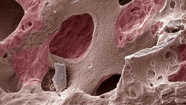 اثبات ایمنی سلول درمانی بیماران مبتلا به آرتروز