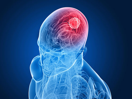 ارائه‌ی راهکار جدید در درمان تومور مغزی