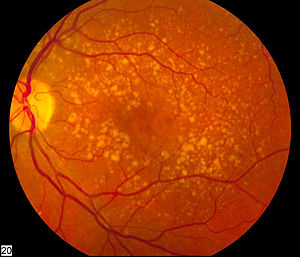 نقش سلول های ایمنی در یکی از شکل های رایج نابینایی ‏